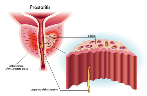 prostatitis gyertya kezelés
