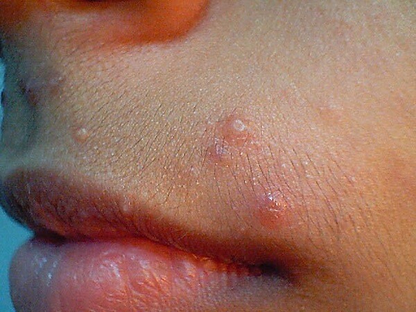 Заразные кожные заболевания | uzalolipetsk