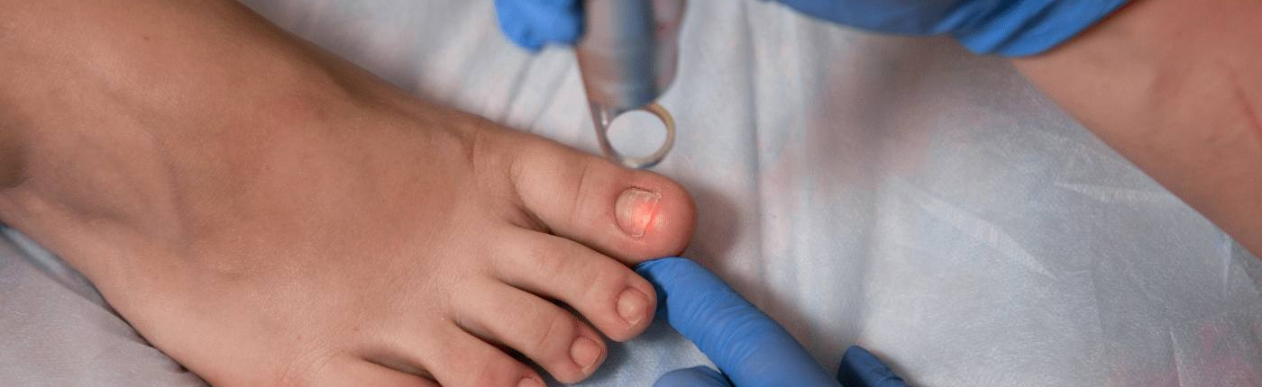 Лечение патологий ногтей неодимовым лазером